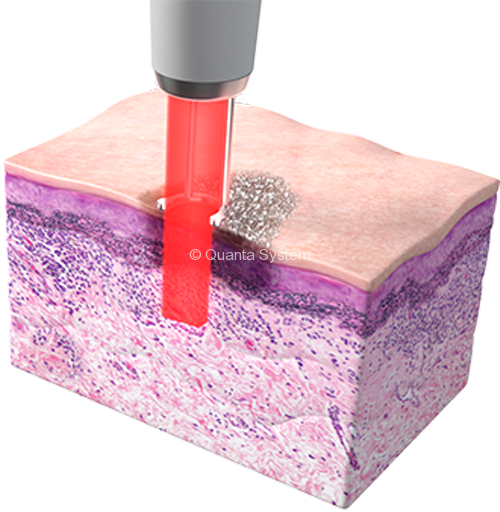 Discovery LesiPigmentate 1064 1 e1525419457875 img