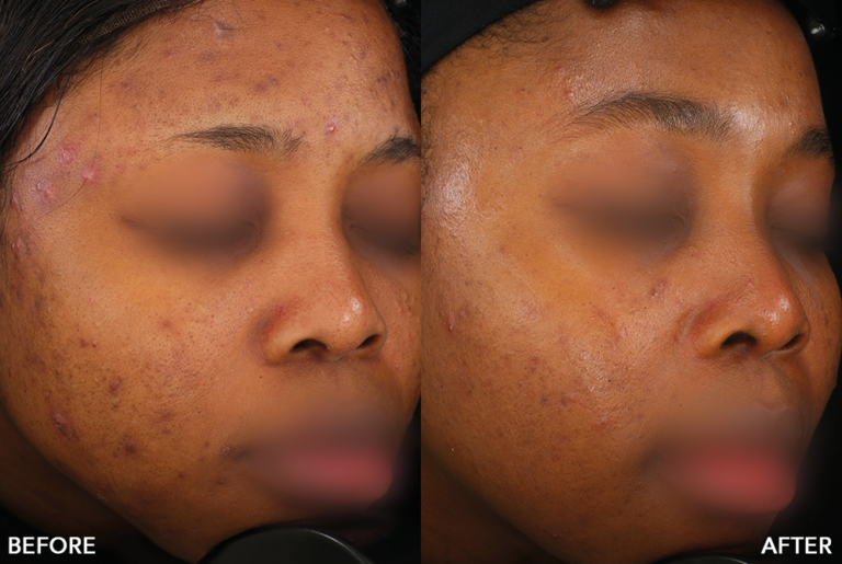 Patient 2 Mod Accure img