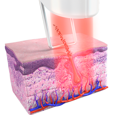 Thunder Epilazione red e1554815922958 450x459 img