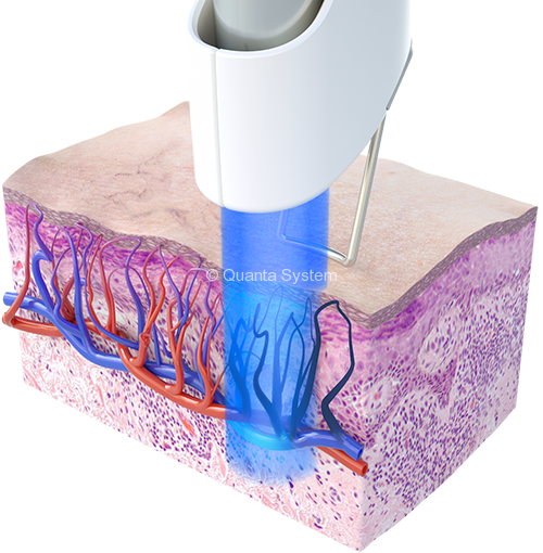 Thunder Vascolare1 blu img