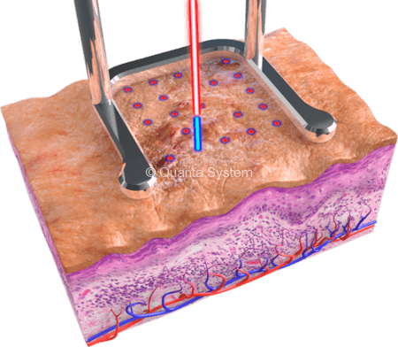 YoulaserMT Acne 450x392 img