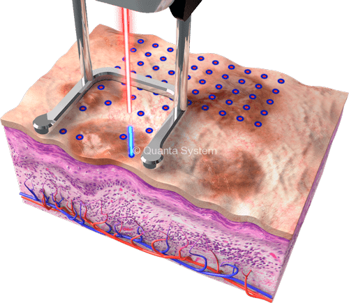 YoulaserMT Mixed Resurfacing img