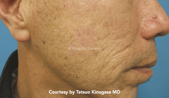 post lesione1 pico img