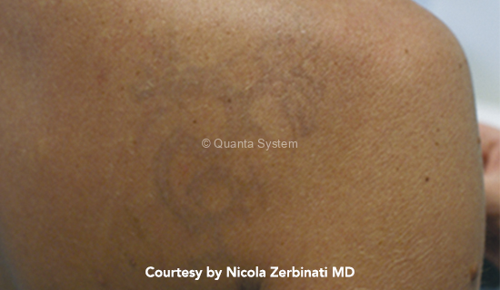 post tattoo1 pico img