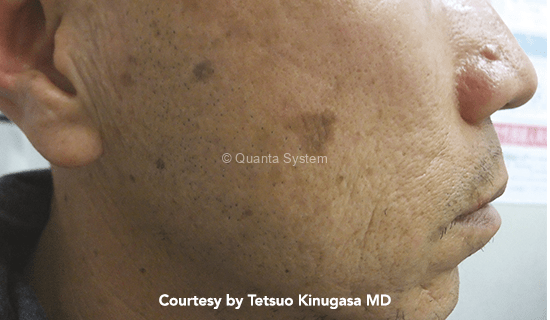 pre lesione1 pico img