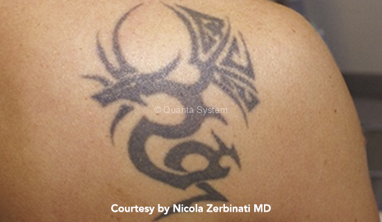 pre tattoo1 pico img