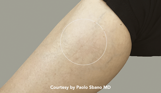 thunder vasc post1 img