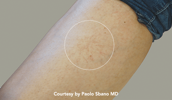 thunder vasc pre1 img