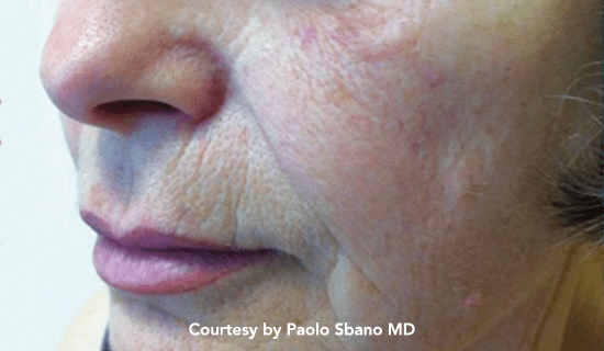 youlaser rej pre1 img