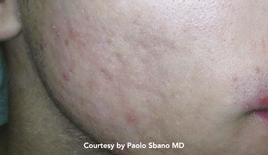 youlaser scars post3 img