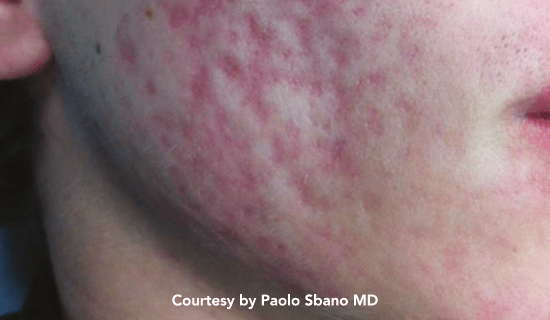 youlaser scars pre3 img