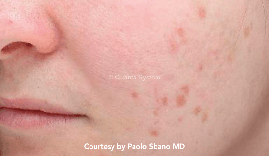 585 pig lesion pre1 img