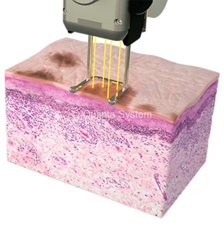 585 LesioniPigmentate 1 e1527062843273 450x461 img