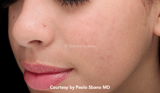 q plus acne post img