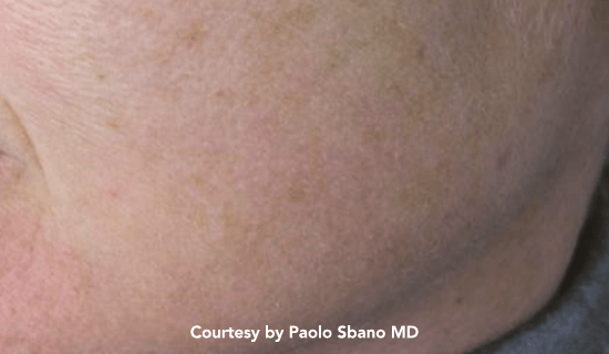 q plus pigmented post1 img