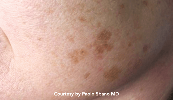 q plus pigmented pre1 img